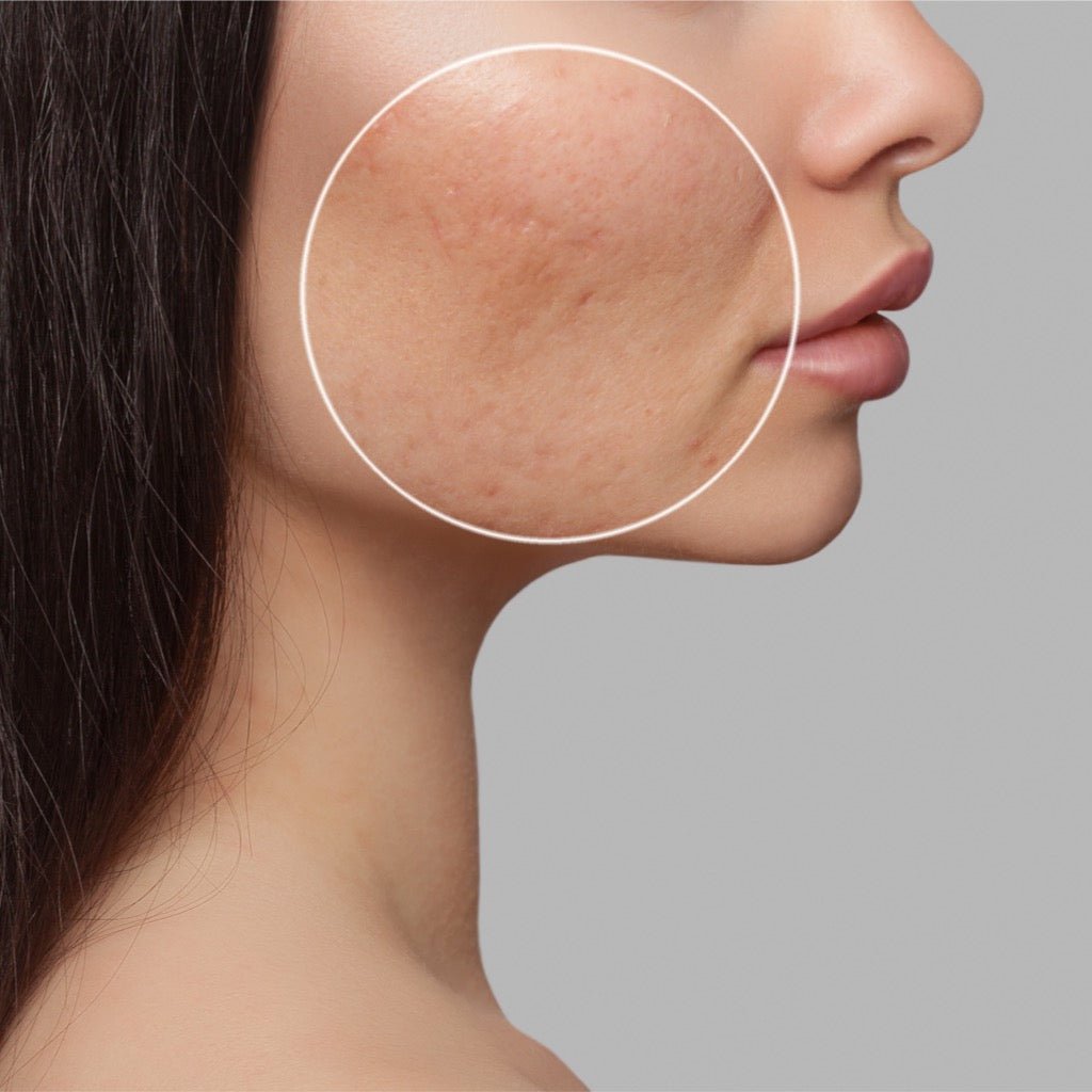 Acne Scars - The DLG Store