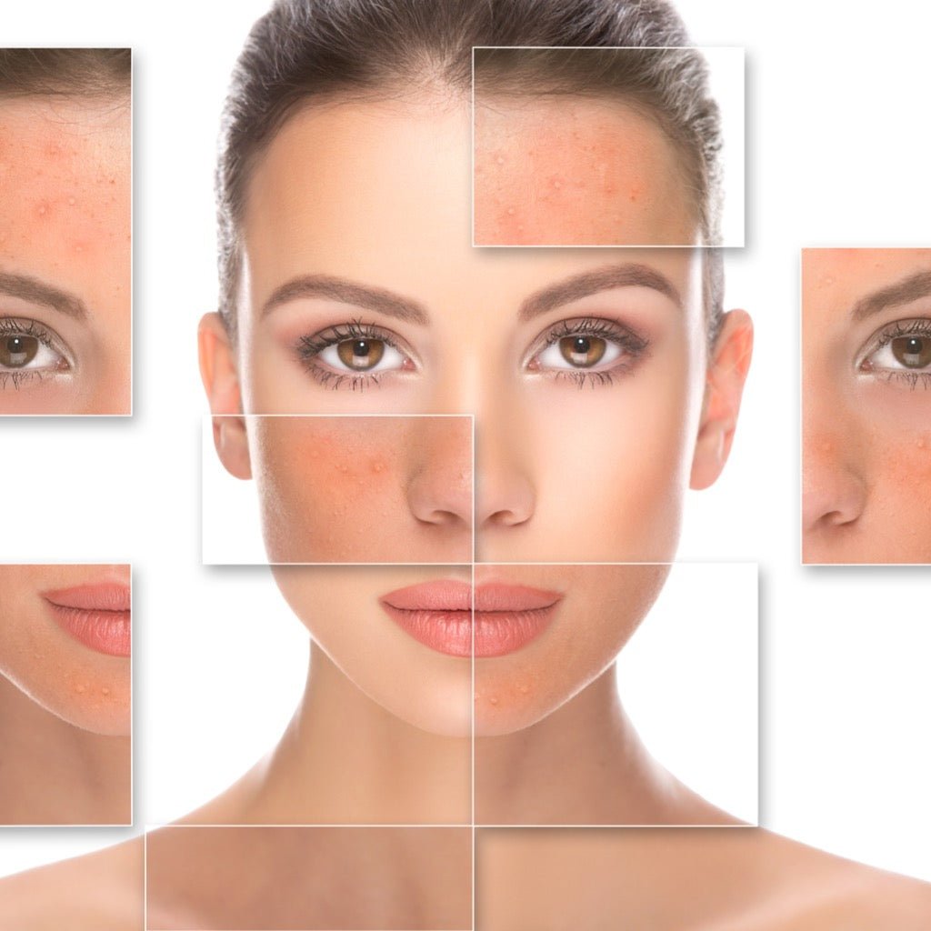Rosacea - The DLG Store