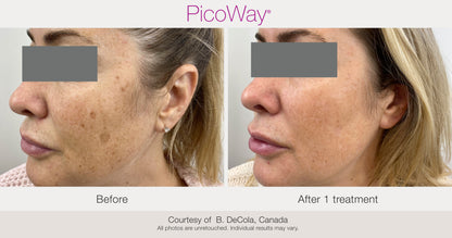Picoway  ® Resolve Laser Rejuvenation in NYC (Package of 3, 5, 10)