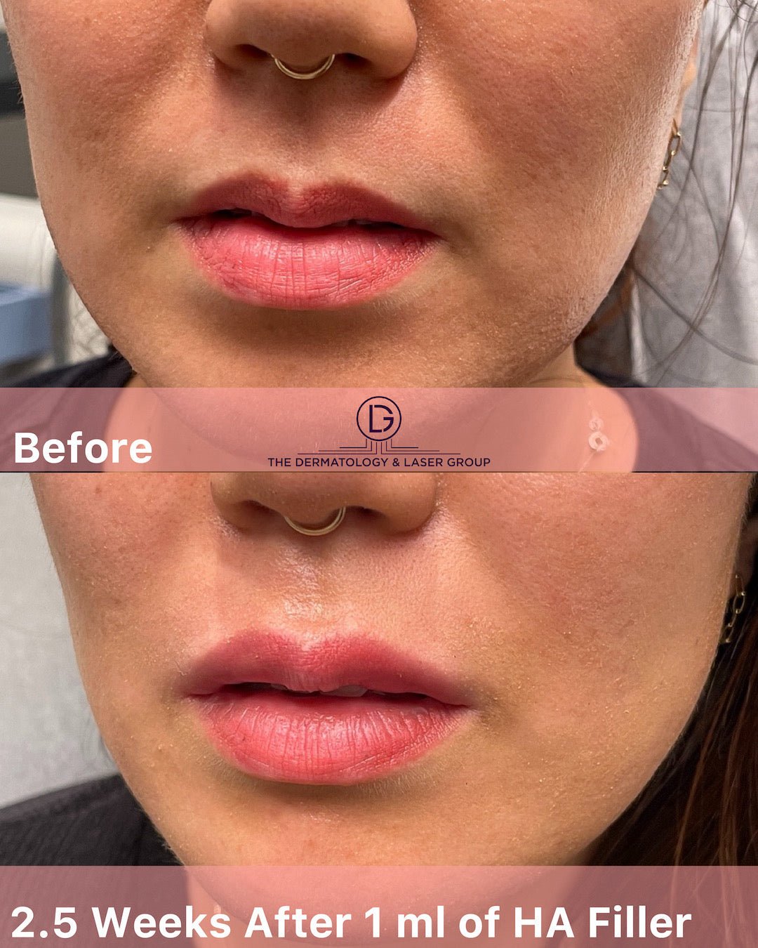 Lip Filler in NYC and other Facial Fillers - The DLG Store