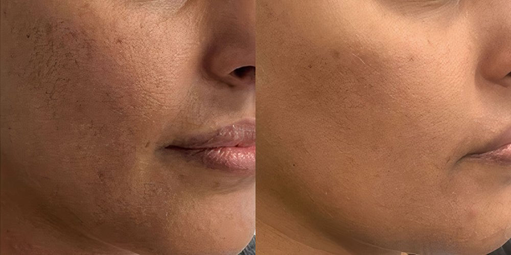 Microneedling with AnteAGE Growth Factor Solution in NYC - The DLG Store
