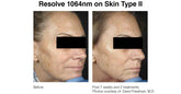 Picoway ® Resolve Laser Rejuvenation in NYC (Packgae of 3, 5, 10) - The DLG Store